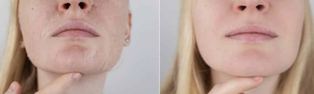 Hyaluronzuur supplementen gezond voor huid en lichaam 4 Hyaluronzuur supplementen gezond voor huid en lichaam 1